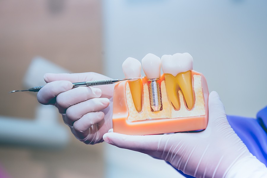 Denture and Dental Implants