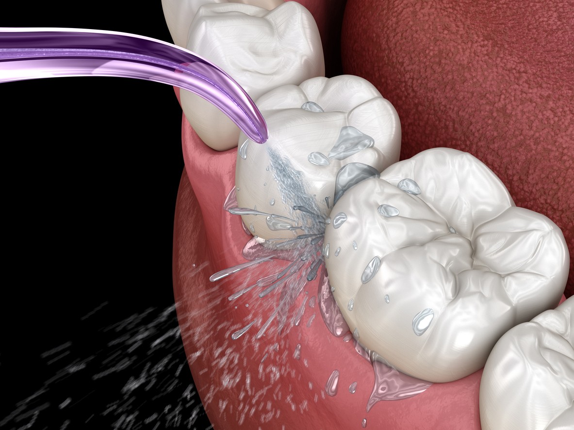 Dental Implants